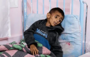 متلازمة نادرة تفتك بسكان غزة: ما هي “غيلان باريه” ولماذا تنتشر الآن؟